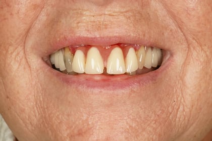 Before patient-designed replacement denture — BDSI Clinic, dentist in Bristol