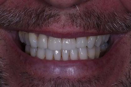 After straightened, brightened & refined — invisalign with 4 emax veneers — BDSI Clinic, dentist in Bristol