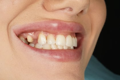 Before closing a long-standing gap with a two-unit bridge — BDSI Clinic, dentist in Bristol
