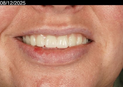 After a first smile in years — upper acrylic denture — BDSI Clinic, dentist in Bristol