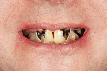 Before full mouth clearance & immediate dentures — BDSI Clinic, dentist in Bristol
