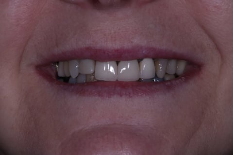 Before digital smile design — 6 layered zirconia crowns — BDSI Clinic Bristol