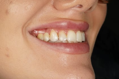 After closing a long-standing gap with a two-unit bridge — BDSI Clinic, dentist in Bristol
