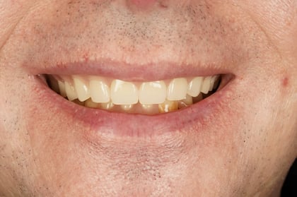 After full mouth clearance & immediate dentures — BDSI Clinic, dentist in Bristol