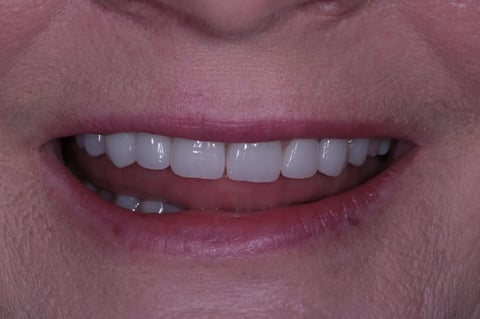 After severe wear restored — 8 zirconia crowns — BDSI Clinic Bristol