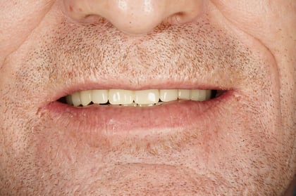 After full mouth reset — upper & lower dentures after clearance — BDSI Clinic, dentist in Bristol