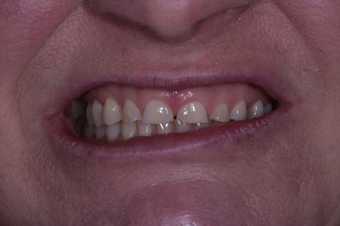 Before severe wear restored — 8 zirconia crowns — BDSI Clinic Bristol