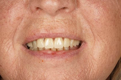 After patient-designed replacement denture — BDSI Clinic, dentist in Bristol