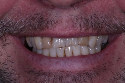 Before straightened, brightened & refined — invisalign with 4 emax veneers — BDSI Clinic, dentist in Bristol
