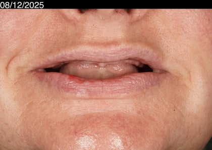 Before a first smile in years — upper acrylic denture — BDSI Clinic, dentist in Bristol