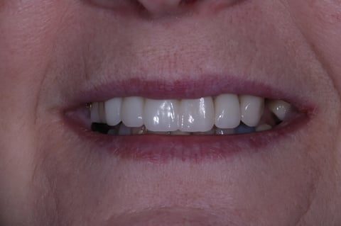 After digital smile design — 6 layered zirconia crowns — BDSI Clinic Bristol