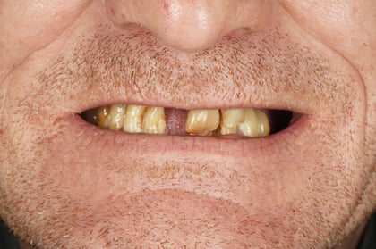 Before full mouth reset — upper & lower dentures after clearance — BDSI Clinic, dentist in Bristol